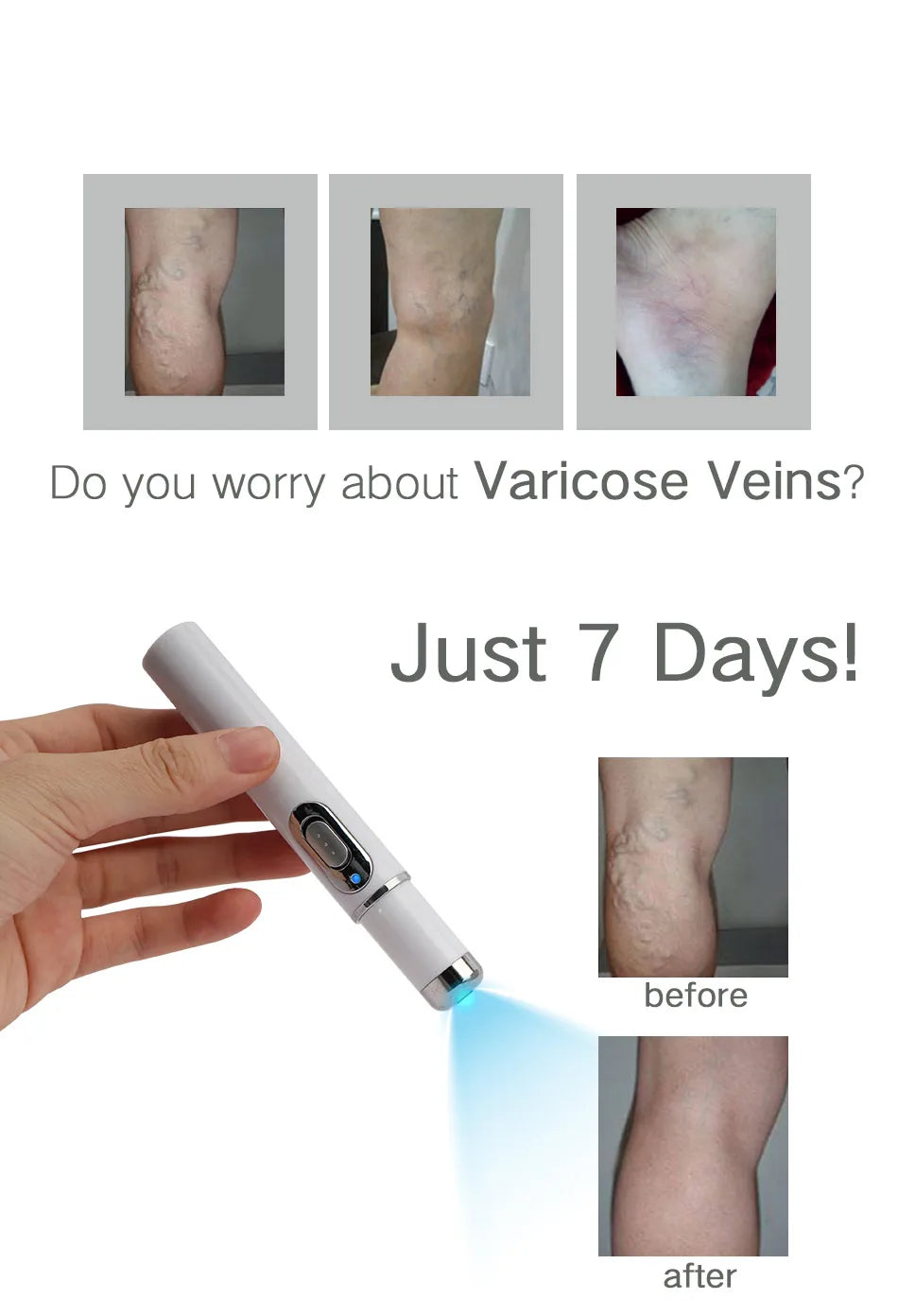 VeinErase™ - Effektiv borttagning av ådernät & spindelvener