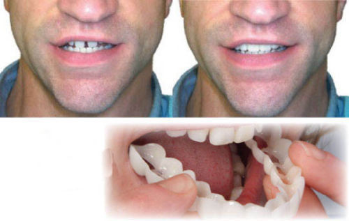 Tandblekning SnapOn™ – Snabbtandsblekning med Tandöverdrag