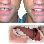 Tandblekning SnapOn™ – Snabbtandsblekning med Tandöverdrag