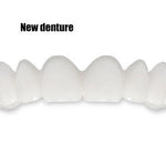 Tandblekning SnapOn™ – Snabbtandsblekning med Tandöverdrag