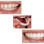 Tandblekning SnapOn™ – Snabbtandsblekning med Tandöverdrag